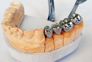 Коронки для зубов - что это и зачем?